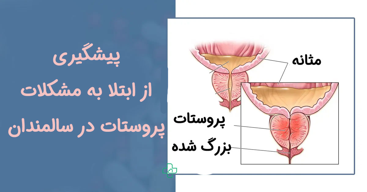 پیشگیری از ابتلا به پروستات در سالمندان