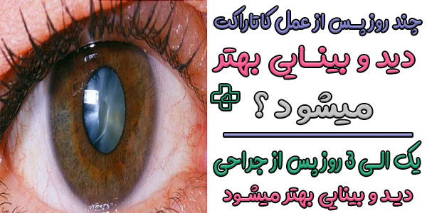 چند روز بعد از عمل آب مروارید بینایی بدست میاد؟
