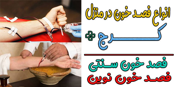 چند روش برای انجام فصد خون در منزل کرج وجود دارد؟