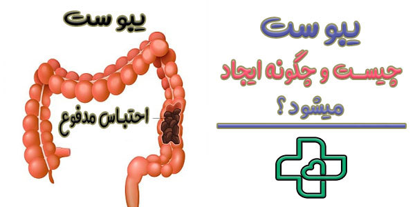 یبوست چیست و به چه علت ایجاد می شود؟